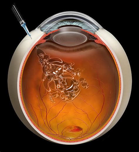 Intravitreal Injection Dr Brighu Swamy Ophthalmic Surgeon