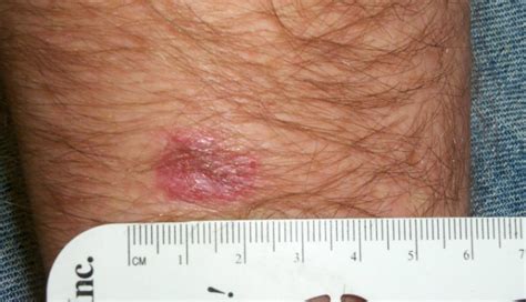 Derm Dx Enlarging Lesion On The Forearm Clinical Advisor