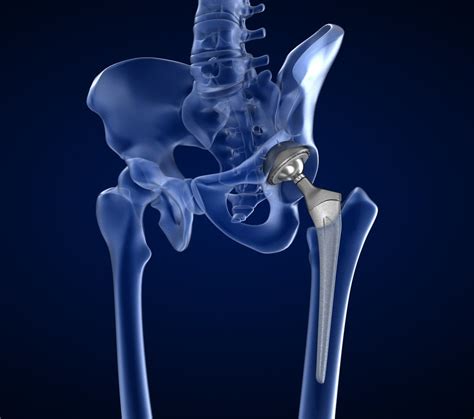 Hip Replacements Riley Physiotherapists