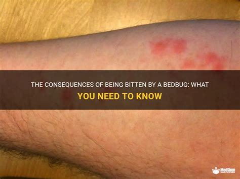 The Consequences Of Being Bitten By A Bedbug What You Need To Know
