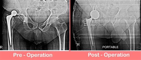 Revision Total Hip Replacement Right Sant Parmanand Hospital