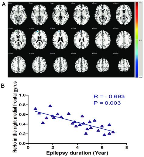 Correlation Between Epilepsy Duration And Reho In Patients With