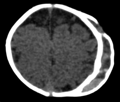 Calcified Cephalohematoma Neurorad911