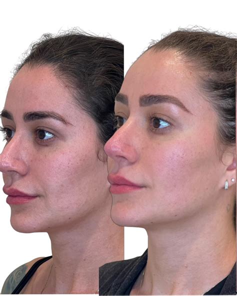 Jawline Fillers Perth Jowl Lift Treatment The Lime Tree Clinic