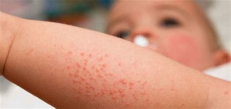 Tips To Recognize Common Fever And Rashes In Children Chickadees