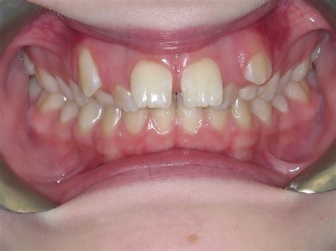 Protruding Teeth Teeth In Line