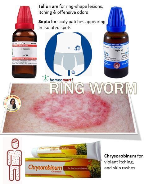 How To Get Rid Of Ringworm Fast Safely And Naturally Homeopathy
