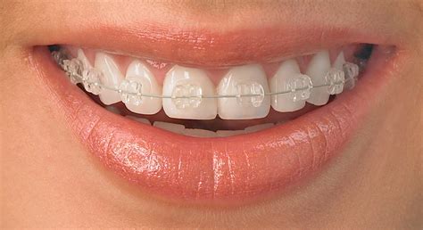 Confira 6 Tipos De Aparelhos Ortodônticos L Conquist Odontologia