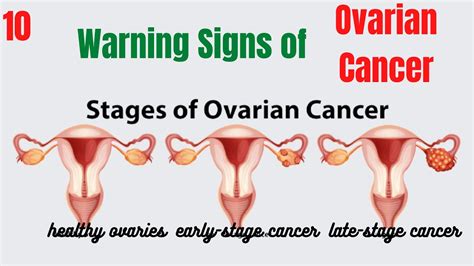 Early Warning Signs Of Ovarian Cancer 10 Obvious Signs Of Ovarian Cancer Youtube