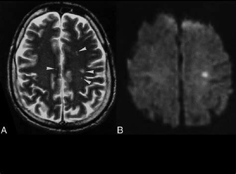 Typical Mri Pattern Of Multiple Small White Matter Lesions A