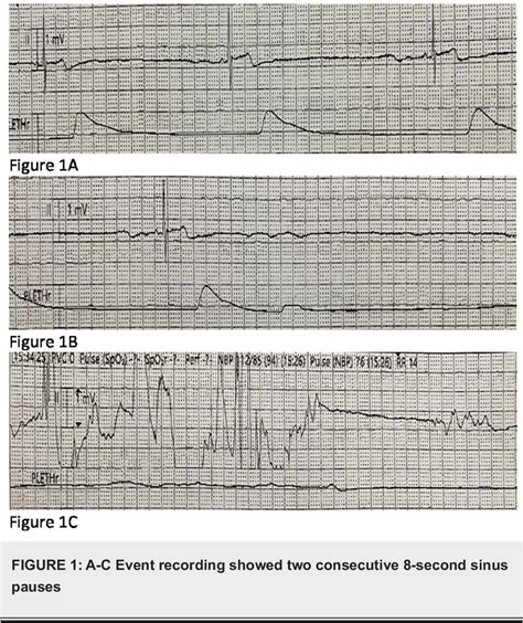 Figure 1 From Role Of Theophylline In Management Of Bradycardia