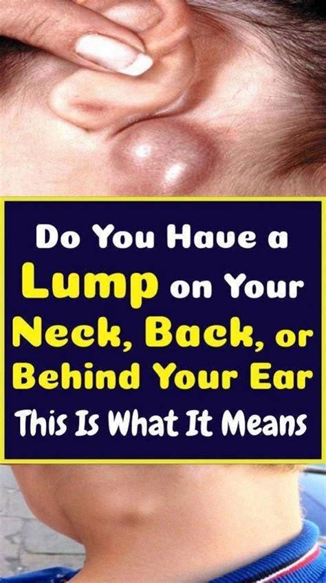Do Youve A Lump On Your Neck Back Or Behind Your Ear That Is What