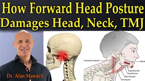 How Forward Head Posture Damages Head Neck And Tmj Dr Mandell Youtube