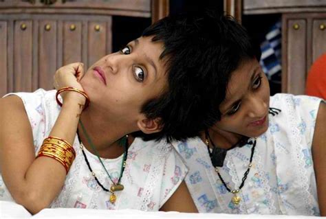 Indian Court Delays Separation Of Twin Sisters Joined At The Head