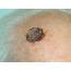 Squamous Cell Carcinoma Of The Skin  John D Boyer MD
