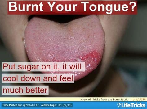 Burns Burnt Tongue Tlcdietnutrition Tlc Diet Healthy Tomorrow Burns