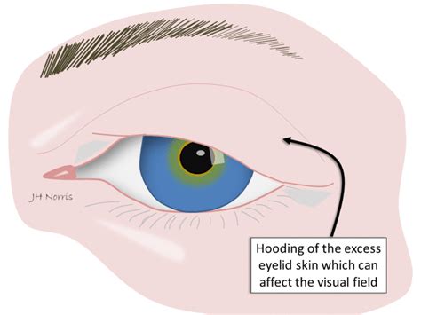 Upper Eyelid Blepharoplasty Jonathan Norris