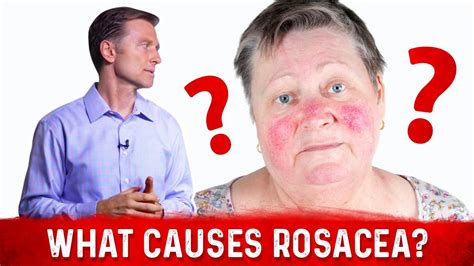 Dr Bergs Opinion On Causes Of Rosacea And Its Treatment Youtube