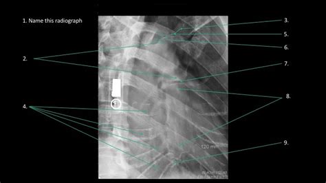 Diagram Rao Sternum Anatomy Xray Diagram Quizlet