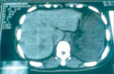 Axial Ct Scan Showing A Multiloculated Cystic Mass In The Right Lobe