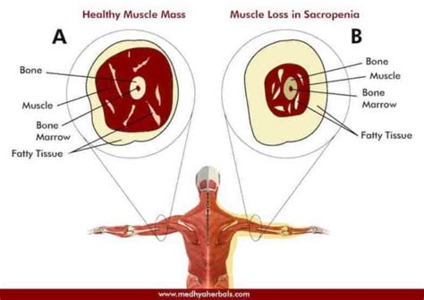 Sarcopenia is a condition of the ageing process in which, the aged person loses balance, his gait all of these symptoms also lead to degeneration of the neuromuscular junction, increase in the oxidative. Sarcopenia - Causes, Symptoms, Management - Medhya Herbals