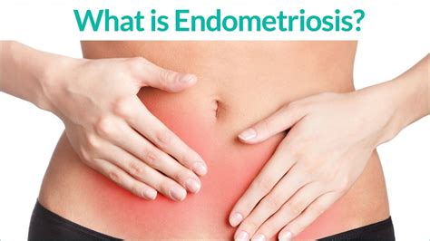 endometriosis did you know 1 in 10 women have this what about you