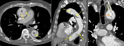 Thoracic Aortic Dissection Ct Radiology At St Vincent