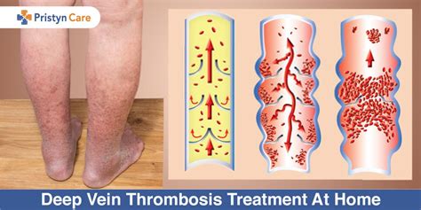 Deep Vein Thrombosis Treatment At Home Pristyn Care