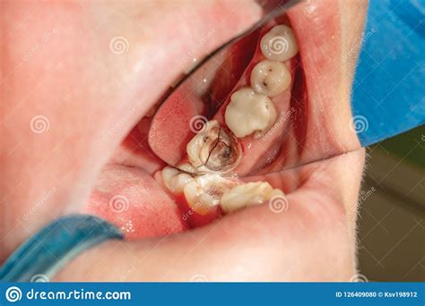 Close Up Of A Fracture Of A Human Molar Tooth Fracture The Concept Of
