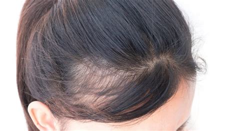 Women And Bald Spots What To Do Blog Keranique