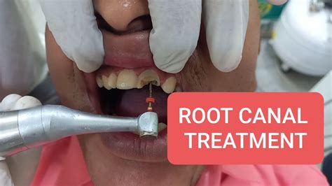 Root Canal Procedure Treatment Youtube