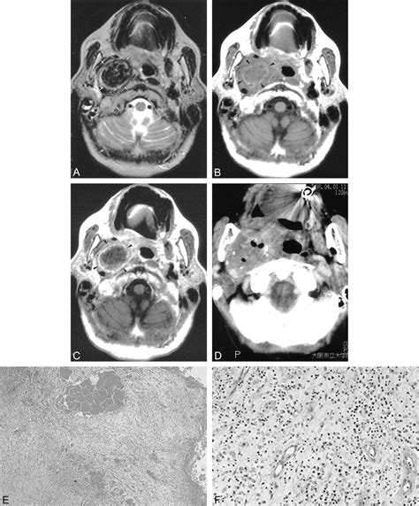 Unusual Ct And Mr Findings Of Inflammatory Pseudotumor In The