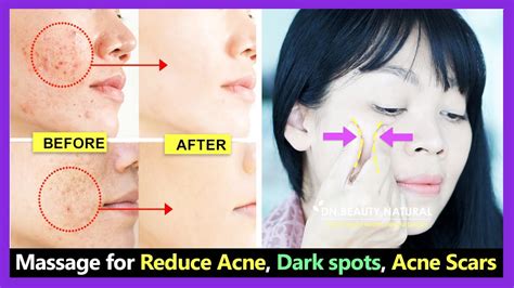 How To Get Rid Of Acne Reduce Open Pores Remove Acne Scars And Dark