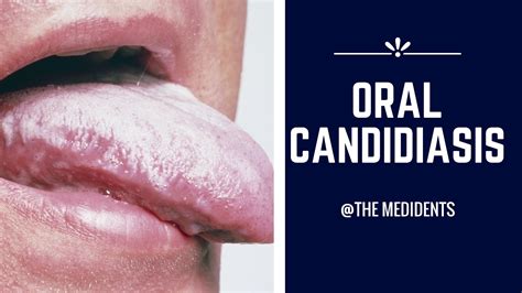 Oral Candidiasis Youtube