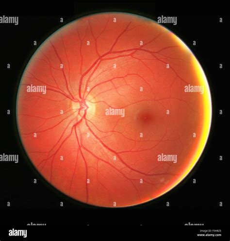 Fundus Photograph Of The Left Eye Showing The Retina Macula Fovea