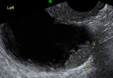 Ovarian Mucinous Cystadenoma Ultrasound Educational Websites Gynecology