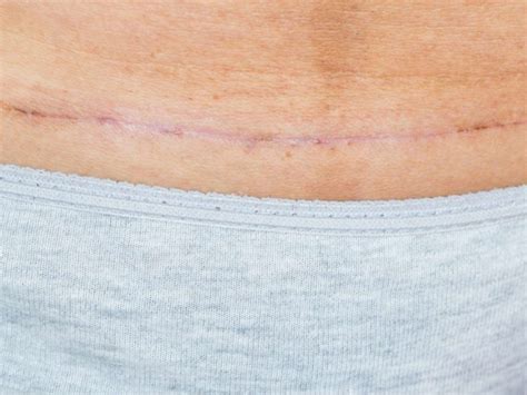 c section incision before and after