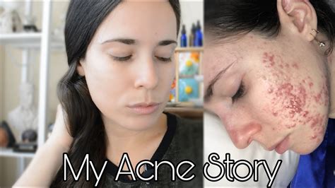 How I Saved My Skin My Acne Story Youtube