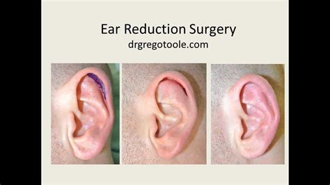 Ear Reduction Surgery Gallery Youtube