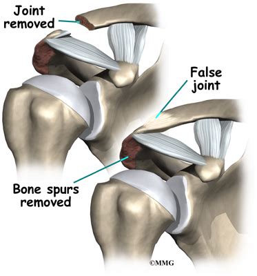 Osteoarthritis Of The Acromioclavicular Joint Orthogate