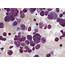 Mast Cell Leukemia