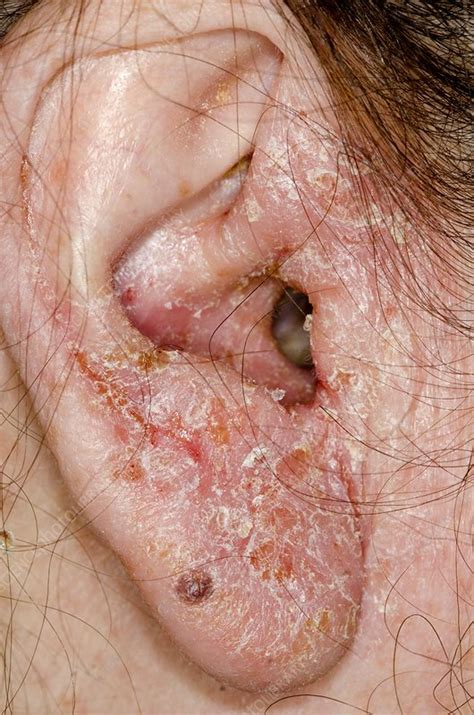 The canal is swollen shut, infected and. Infected outer ear - Stock Image - C013/5805 - Science ...