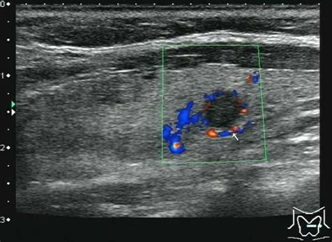 To create an image of the thyroid, the ultrasound. Ultrasonic features of papillary thyroid microcarcinoma ...