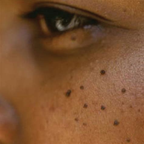 Dermatosis Papulosa Nigra Jh Skincare Clinic Minor Cosmetics Skin