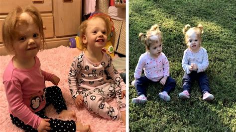 Formerly Conjoined Twins Thriving After Successful Chop Surgery