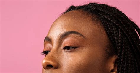 Pimples On Hairline Causes Treatment And Prevention