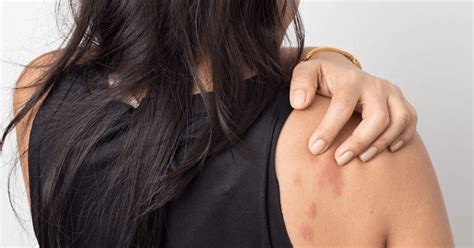 Stress Rashes Causes Symptoms And 5 Effective Treatment