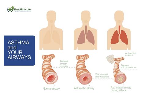 Asthmatic Lungs Biokineticist Andries Lodder Bio4me