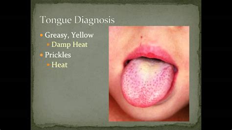 Tongue Diagnosis Example 4 Diagnostic Methods In Chinese Medicine