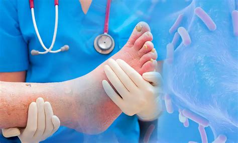 What Is Foot Cellulitis How To Prevent It And When To Worry